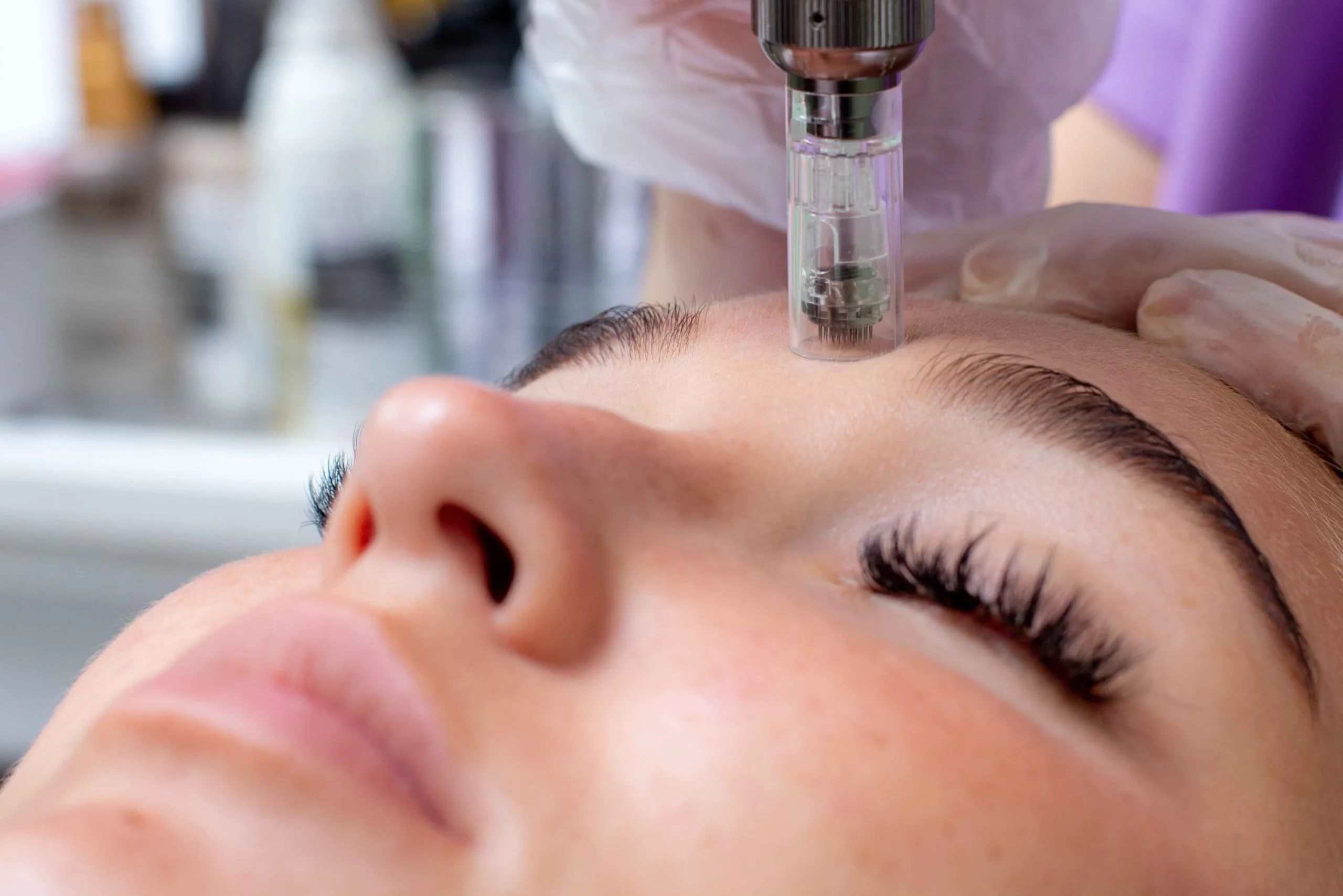 Microneedling-portfolio-Revive Med Aesthetics