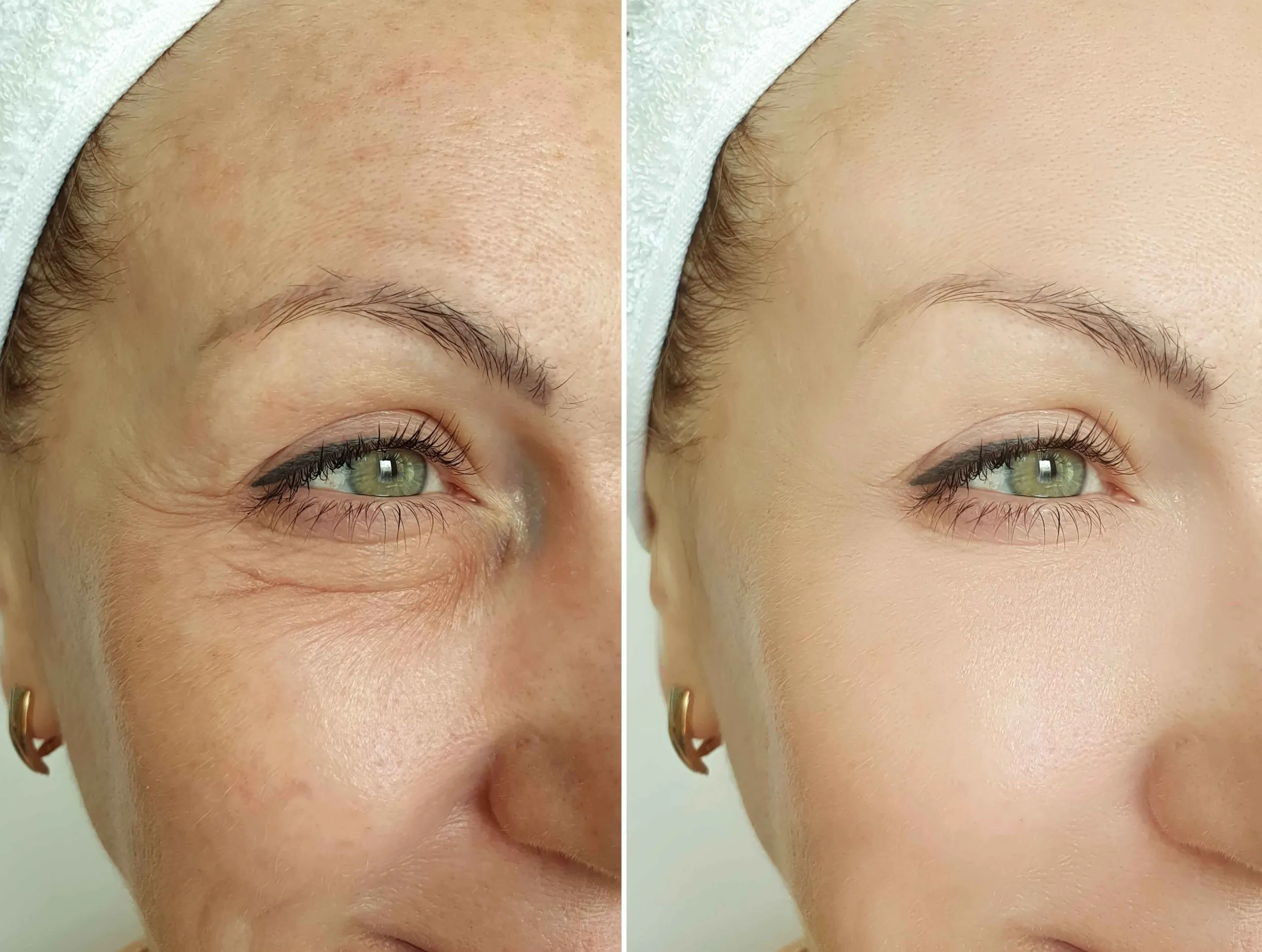 Wrinkle relaxers Before & Afters | Revive Med