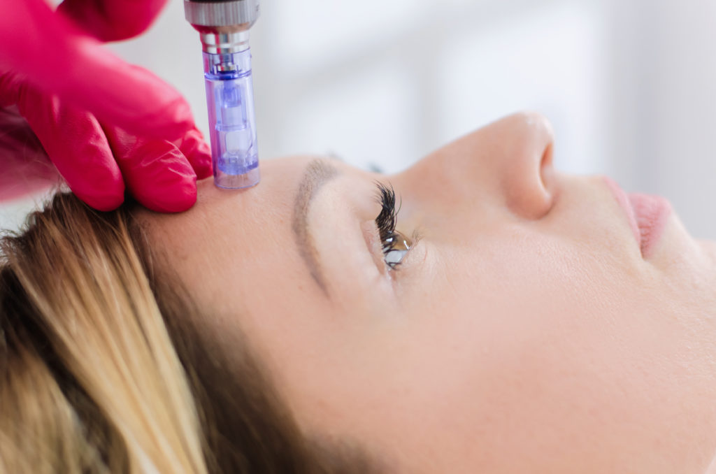 What is the Microneedling of the Face-Fredericksburg, VA