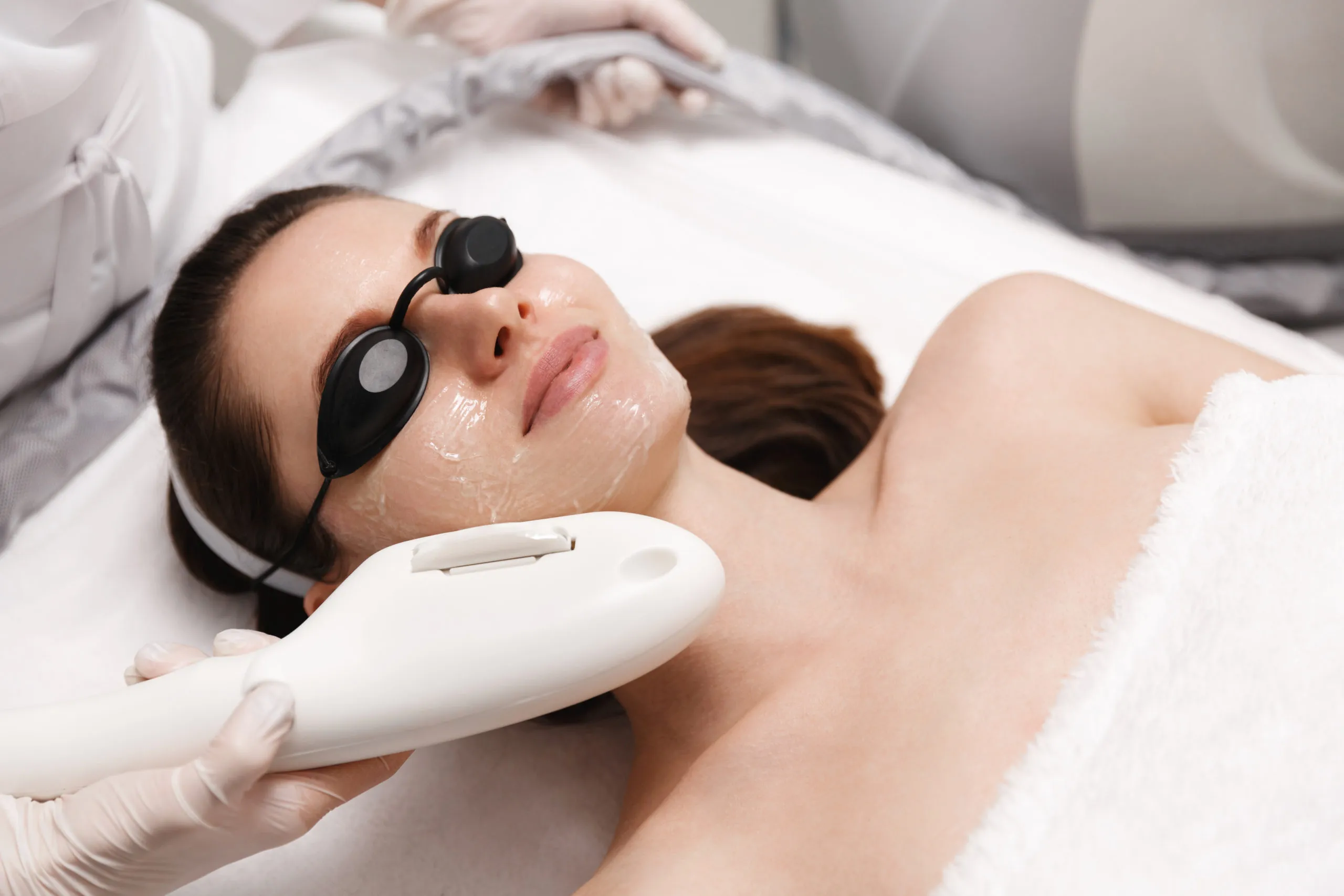 gentlemax-pro-photofacial-fredericksburg-virginia