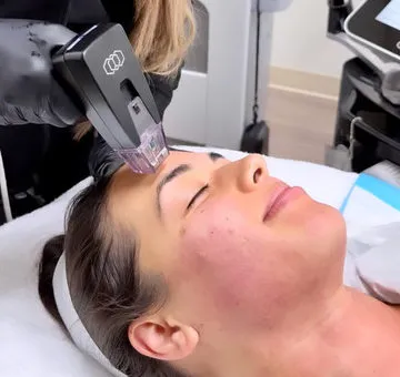 Lady getting Morpheus8 Face and Body | Revive Med