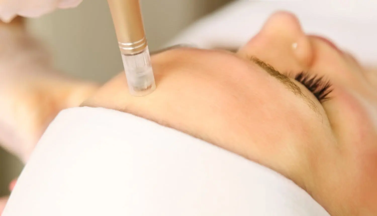 Woman receiving microneedling treatment for acne scars